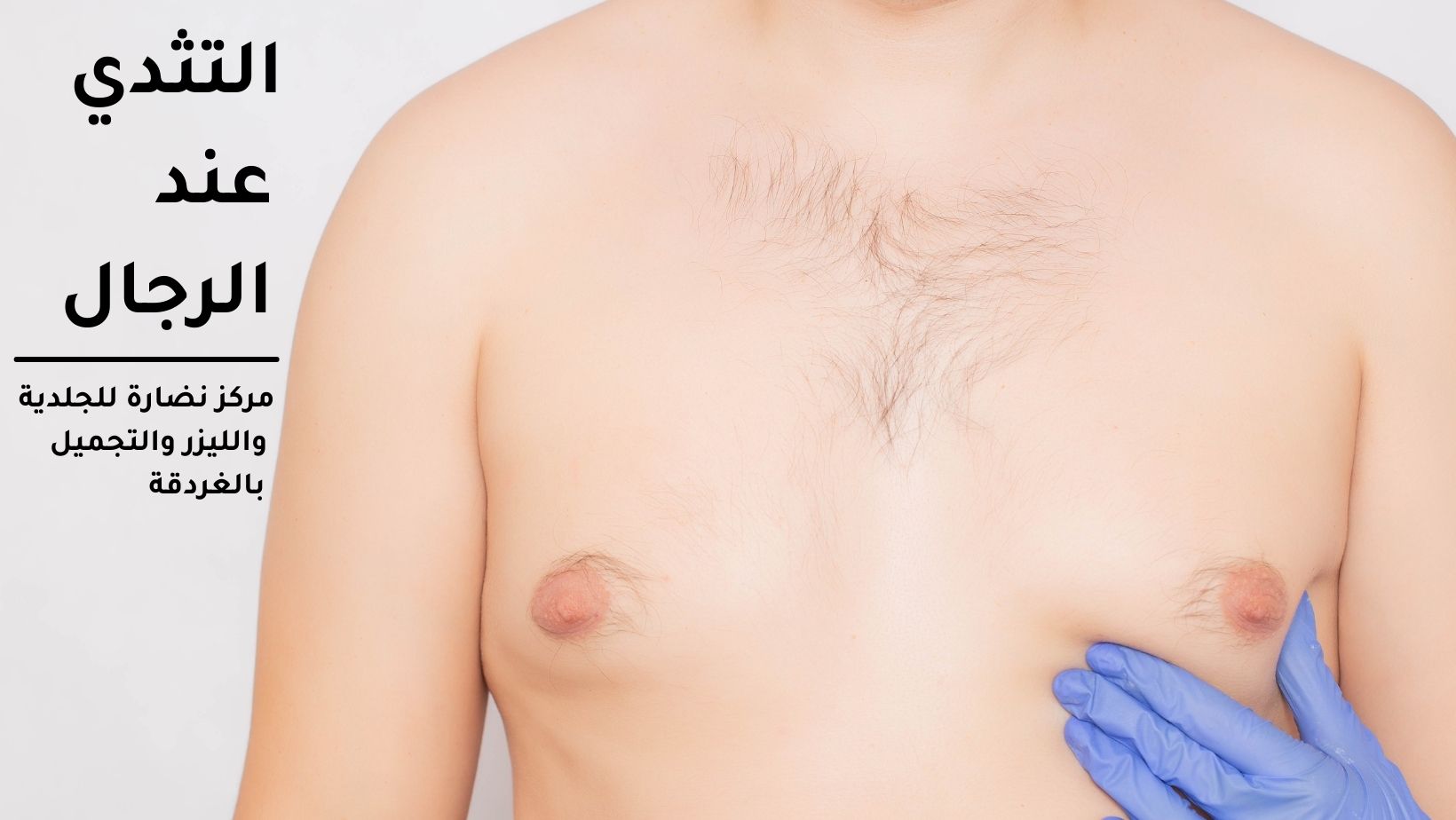 Gynecomastia in men